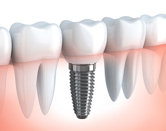 implant dentist warner robbins GA